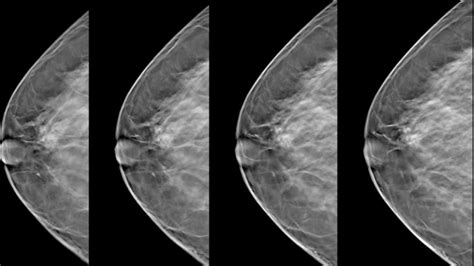 mammography leesburg fl|3d Tomosynthesis, 3d Mammograms .